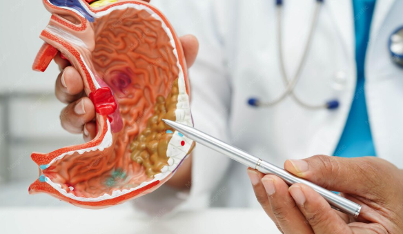 Úlcera péptica: qué es, cómo se diagnostica y qué significa verla en una endoscopia digestiva
